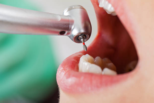 Best Emergency Wisdom Tooth Extraction in Braddock Heights, MD